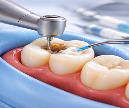 Mutlukent diş dolgu işlemleri yapan Dent Alyans Diş Kliniği tarafından yapılan Mutlukent kompozit dolgu ve amalgam dolgu işlemleri