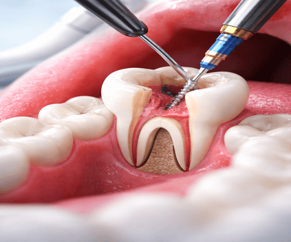 Çayırova kanal tedavisi yapan Dent Alyans Diş Kliniği ile dolgu, diş çekimi ve kanal tedavisi işlemleri