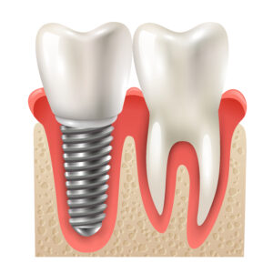 All-on-four implant ve all-on-six implant tedavisinde uzmanlaşmış Dent Alyans Diş Kliniği tarafından hazırlanmış bir implant görseli